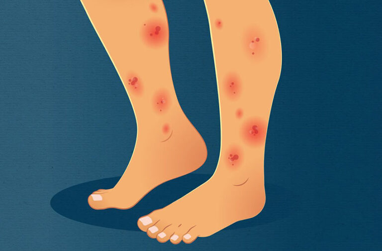 Women's Compression Stocking All You Should Know Knowles Wellness