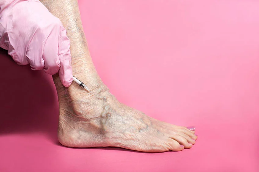 Sclerotherapy on the foot