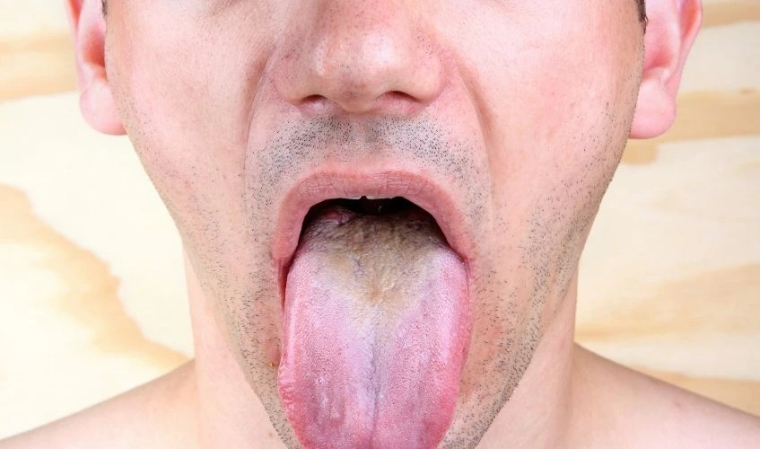 Bacterial infection disease tongue in a man