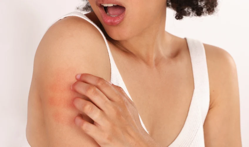 Woman suffering from Skin irritation