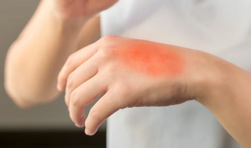Red Burn on Top of a Hand