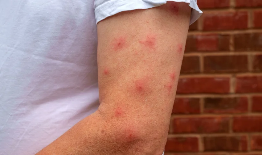 Allergic reaction to mosquito bites
