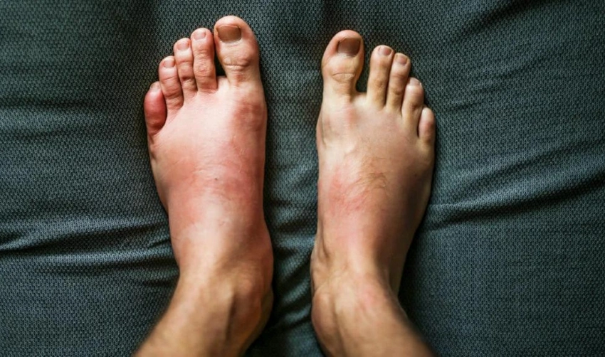 Drug allergy swelling in legs