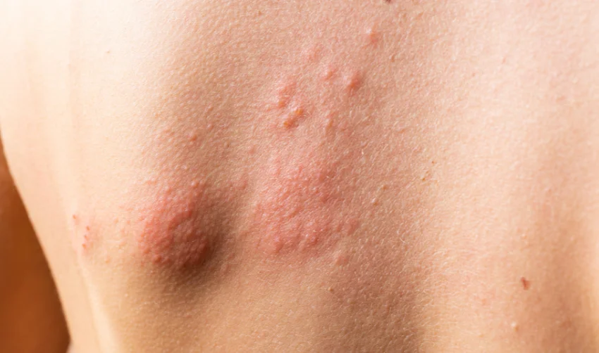 Skin Rash and Blisters on Body