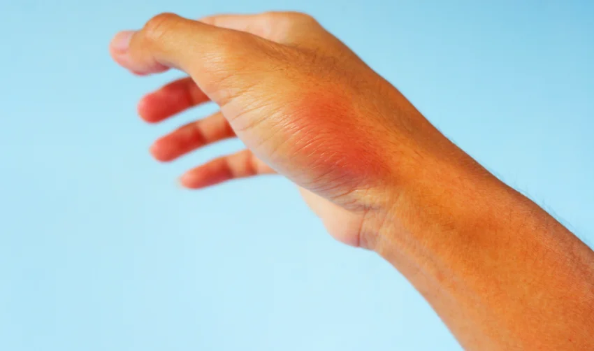 Swelling Symptom and Red Skin on Hand
