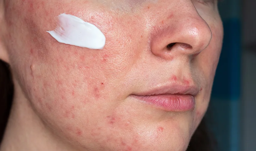 medicated ointment on woman face with rosacea close up